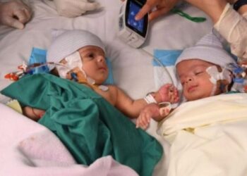 സല്‍മാനും അബ്ദുള്ളയ്ക്കും ഇനി രണ്ട് പേരായി ജീവിക്കാം: സായാമീസ് ഇരട്ടകളെ വിജയകരമായി വേര്‍പ്പെടുത്തി സൗദി ആശുപത്രി