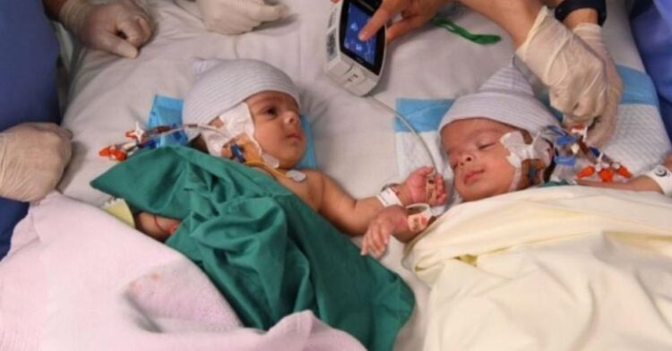 സല്‍മാനും അബ്ദുള്ളയ്ക്കും ഇനി രണ്ട് പേരായി ജീവിക്കാം: സായാമീസ് ഇരട്ടകളെ വിജയകരമായി വേര്‍പ്പെടുത്തി സൗദി ആശുപത്രി